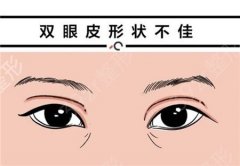 微创双眼皮手术的方法有几种？