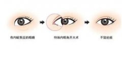 做双眼皮手术有几种方法？