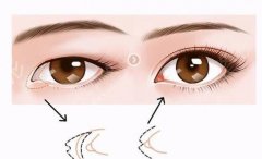 做双眼皮手术的优点和缺点是什么？