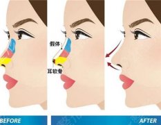 隆鼻手术有哪些缺点,为什么会发生穿孔