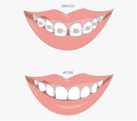 牙缝大了怎么修复？介绍几种有效的修复方法