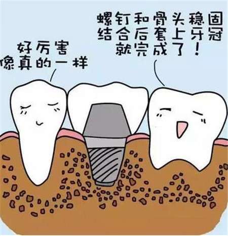 种植牙能用多少年？如何才能延长种植牙的使用寿命？