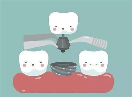 种植牙能不能用一辈子？影响种植牙使用寿命的关键因素是什么？