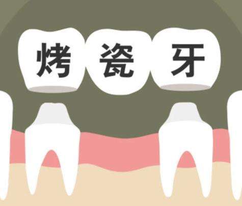 牙齿做牙冠多少钱一颗？看完此篇选择适合自己的牙冠修复方案。