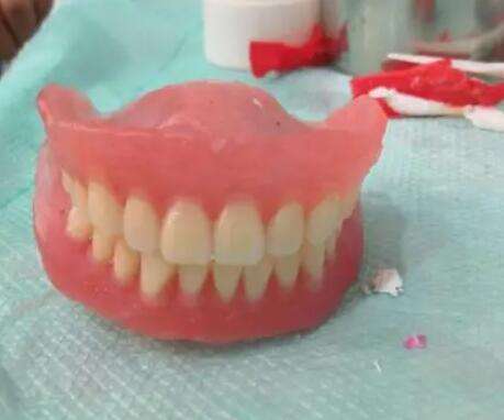 什么是树脂牙？树脂牙好不好？