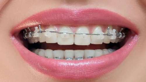 门牙牙缝2mm要多久矫正？矫正牙齿的方式分享