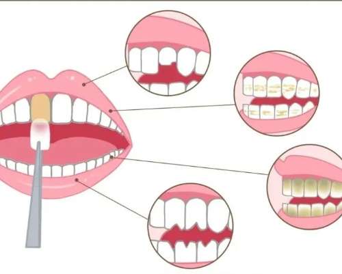 牙缝大可以做牙贴面吗？了解个人情况看看是否适合这种修复方法。