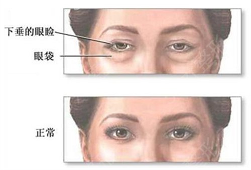 重庆西南医院美容科祛除眼袋果怎么样？案例果前后明X！